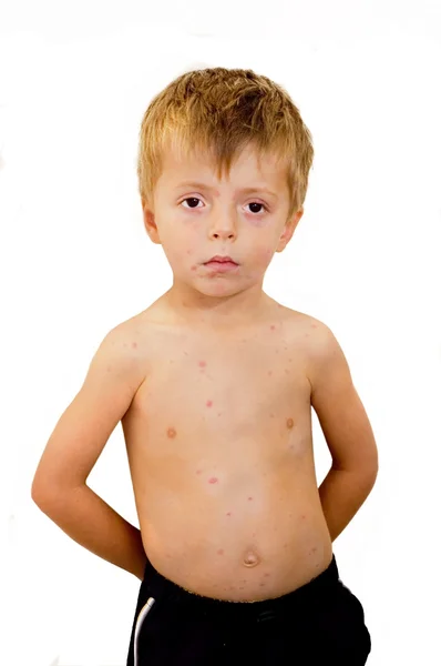 Garçon avec varicelle . — Photo
