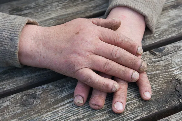 Infección por hongos en las uñas — Foto de Stock