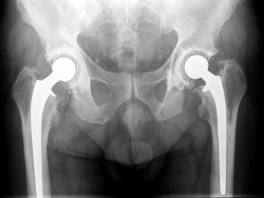 X-ray of hip clipart