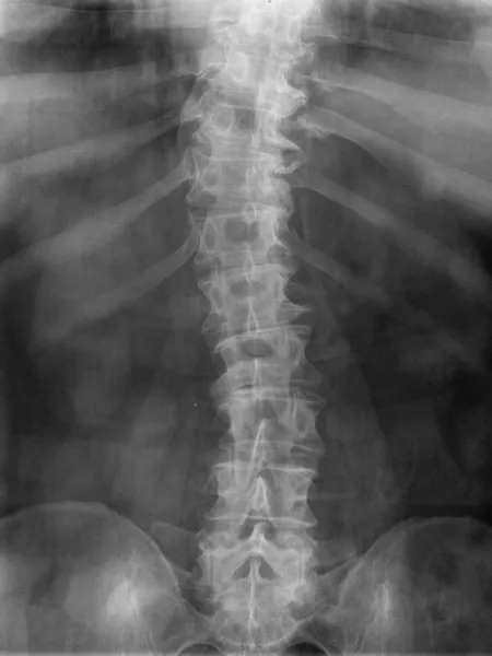 Imagen de rayos X de los huesos de la columna vertebral — Foto de Stock