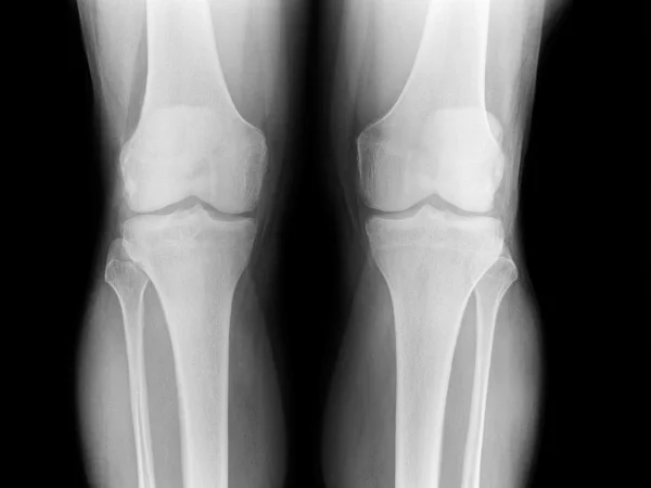 Radiografía de la rodilla — Foto de Stock