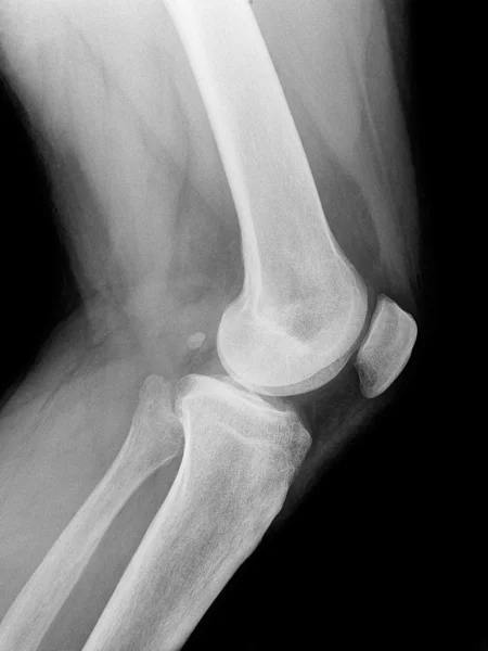 Raios-X do joelho — Fotografia de Stock