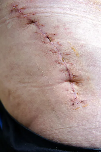 Cicatrice après chirurgie — Photo