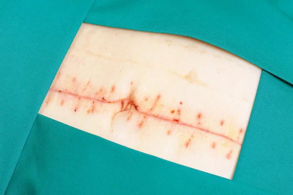 Cicatriz sobre abdômen após a cirurgia — Fotografia de Stock
