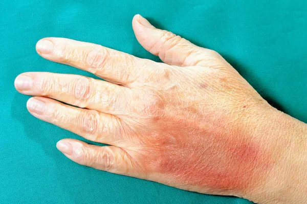 Mão humana após violência física — Fotografia de Stock