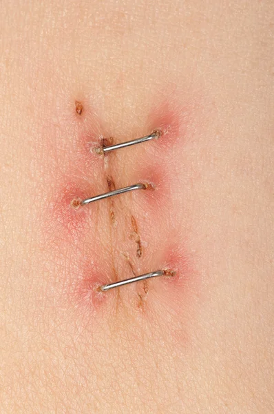 stock image Surgery Incision