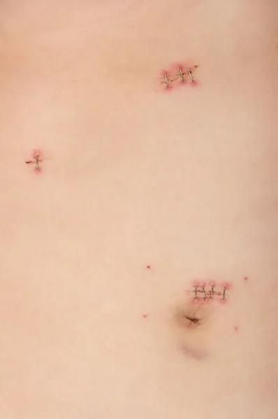 Surgery Incisions — Stock Photo, Image