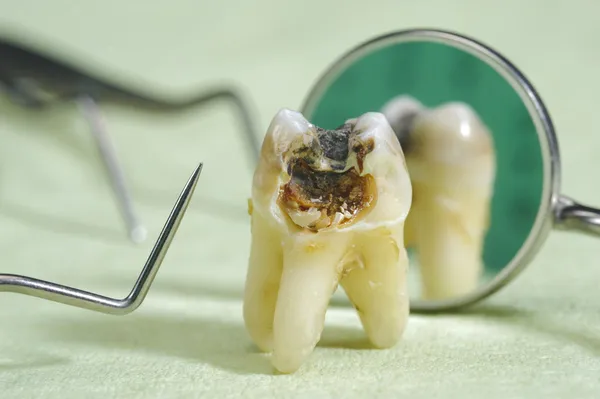 Кариатиды на зубах — стоковое фото