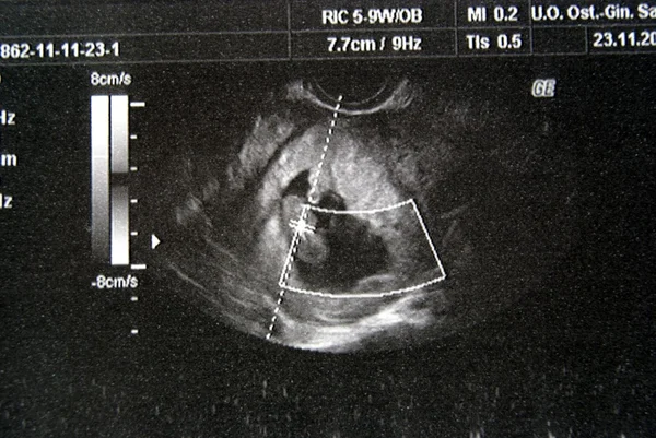 Ultrasound of my little baby — Stock Photo, Image