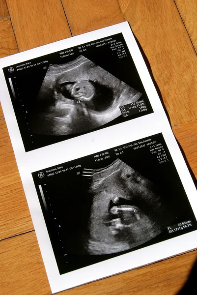 Ultrasound for a new life — Stock Photo, Image