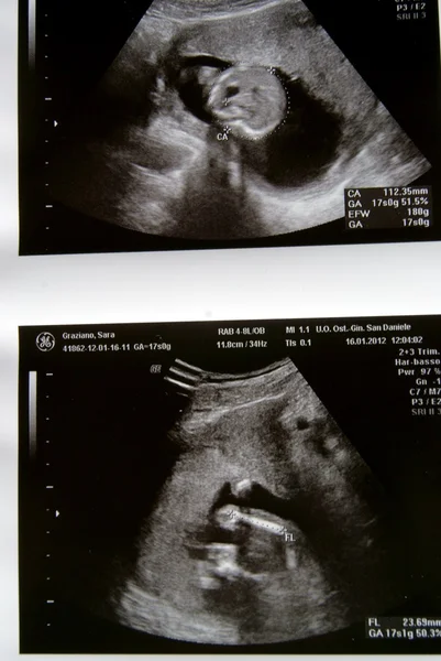 Ultrazvuk pro nový život — Stock fotografie