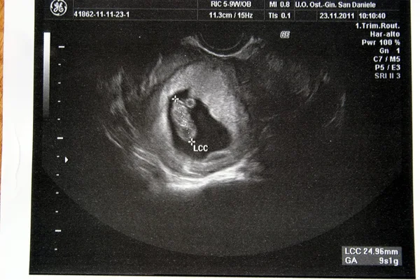 Ultraschall meines kleinen Babys Stockbild