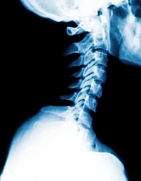 Radiografia de raios-X do pescoço — Fotografia de Stock
