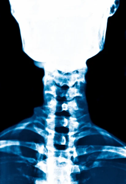 X-Ray radiography of the neck — Stock Photo, Image