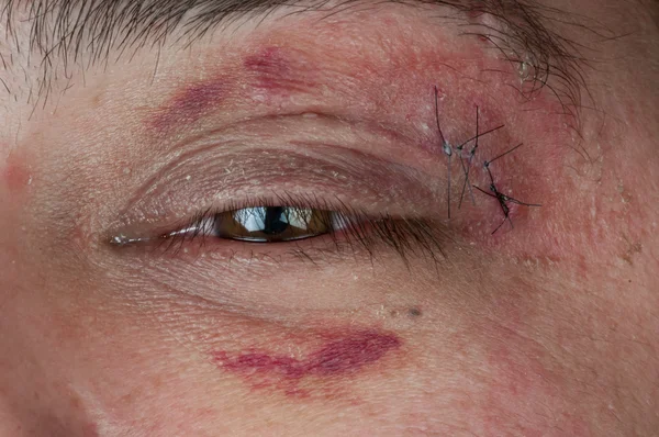 Close-up de uma ferida costurada — Fotografia de Stock