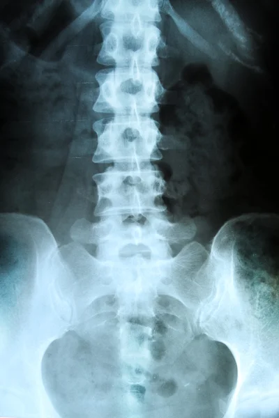 stock image X-ray of the pelvis and spinal column.