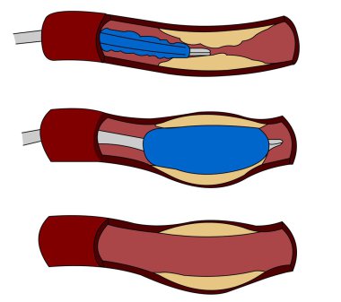 Stent angioplasty clipart