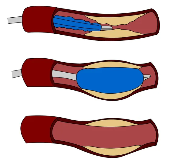 Angioplastia del stent — Vector de stock