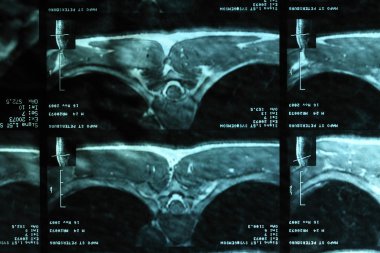 Mri of a backbone clipart