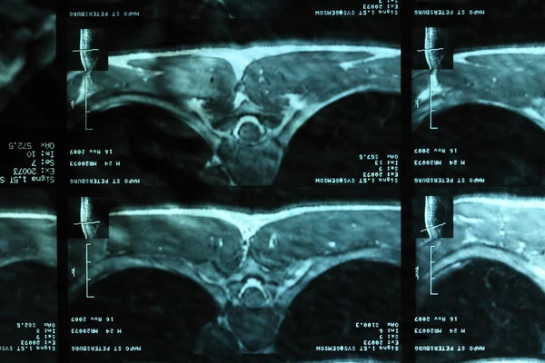 MRI van een ruggengraat — Stockfoto