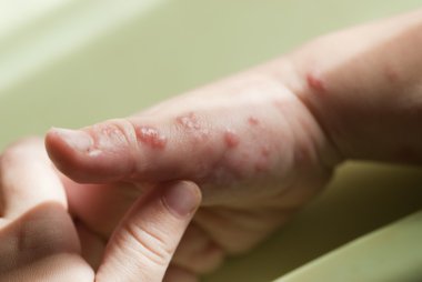 Herpes zoster in a child hand. clipart