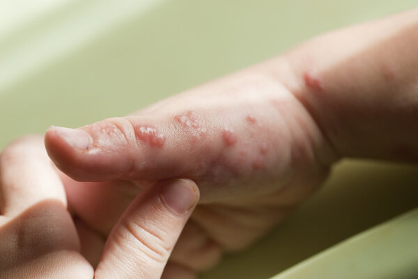 Herpes zoster in a child hand.