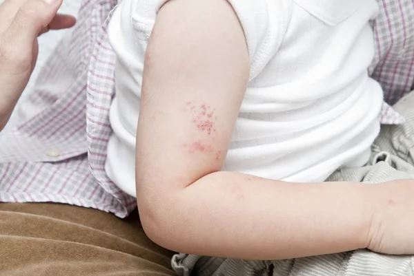 在孩子的手臂疱疹. — 图库照片
