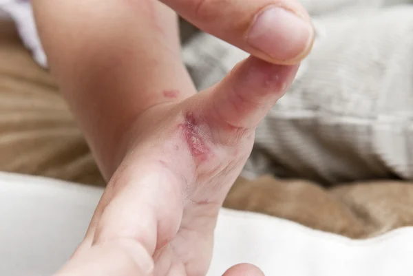 Stock image Herpes zoster in a child hand.