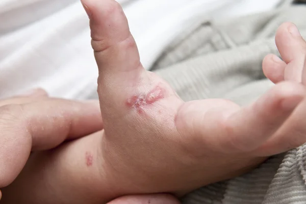 Herpes zoster v rukou dítěte. — Stock fotografie