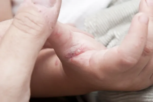 Herpes zoster en la mano de un niño . —  Fotos de Stock