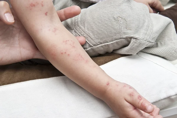 Herpes en un brazo de niño . — Foto de Stock