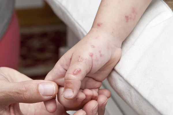 Herpes zoster i en barn hand. — Stockfoto