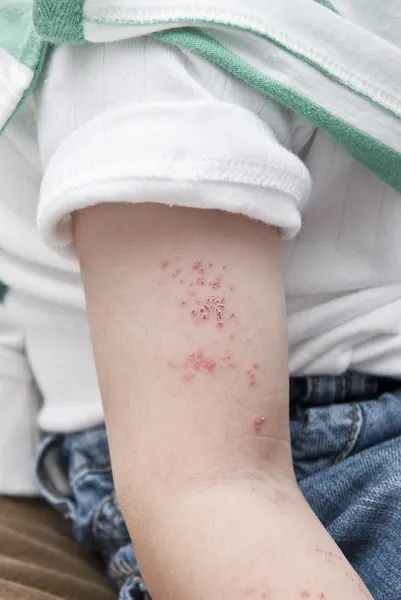 Herpes nel braccio di un bambino . — Foto Stock