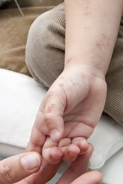 Herpes zoster in de hand van een kind. — Stockfoto