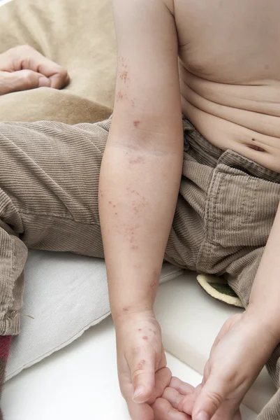 Herpes i en barn-arm. — Stockfoto