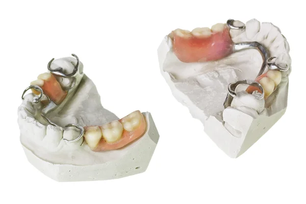 치아와 의치의 석고 캐스팅 — 스톡 사진