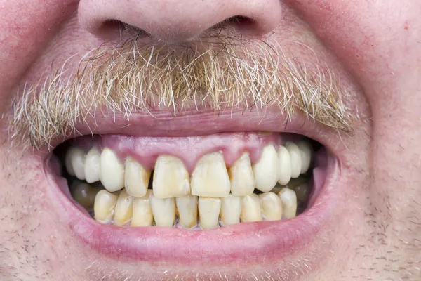 노란 치아는 아픈 스튜디오 샷 — 스톡 사진