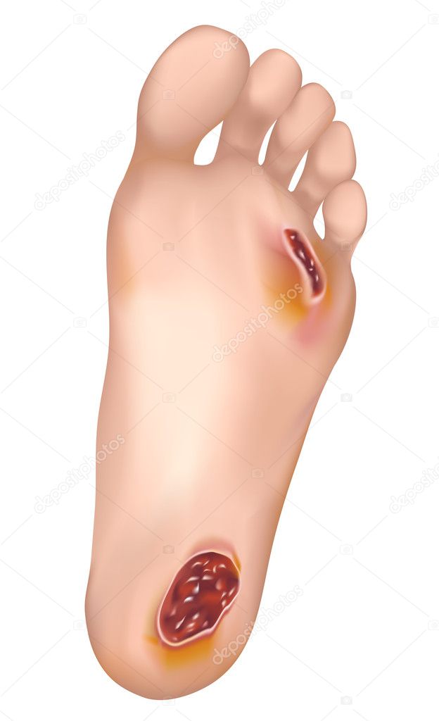 Diabetic foot.