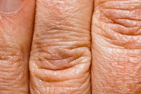 干性皮肤 — 图库照片