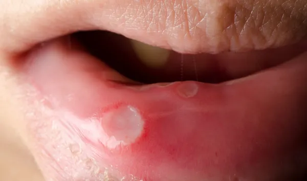 Úlcera dental en la boca —  Fotos de Stock