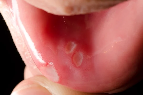 Dentystycznych owrzodzenia jamy ustnej — Zdjęcie stockowe
