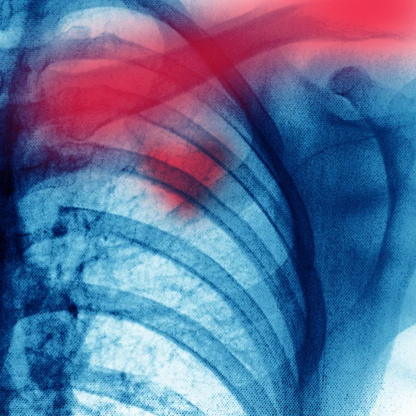 Radiografia do tórax — Fotografia de Stock