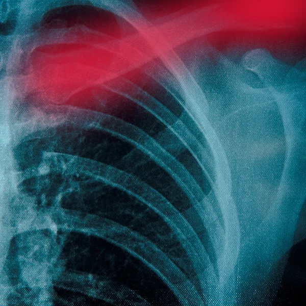 Radiografia do tórax — Fotografia de Stock