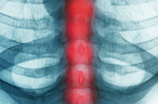 Radiografía de pecho — Foto de Stock
