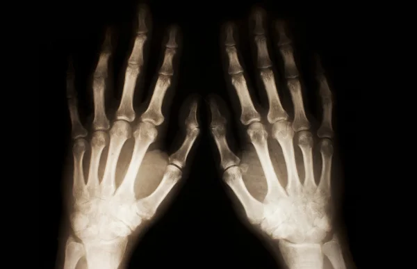 Röntgen av händer — Stockfoto