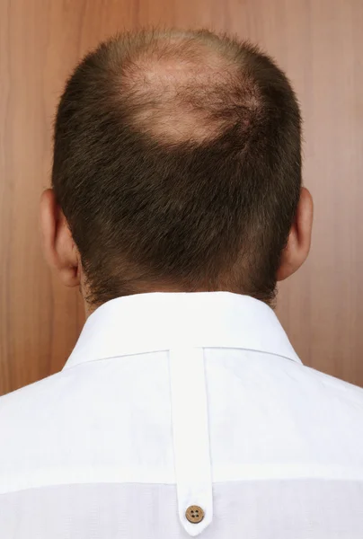 Bald spot — Stock Photo, Image