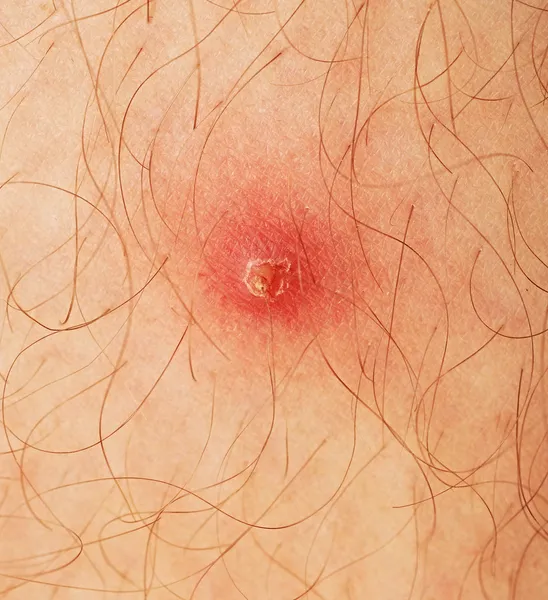 Pimple extreme on human skin. macro — Stock Photo, Image