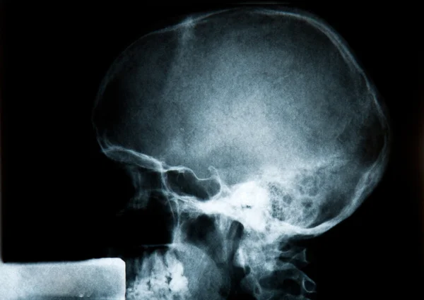 Bionic Man Profile on X-Ray — Stock Photo, Image