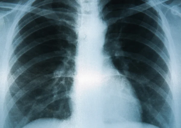 Chest X-ray image — Stock Photo, Image