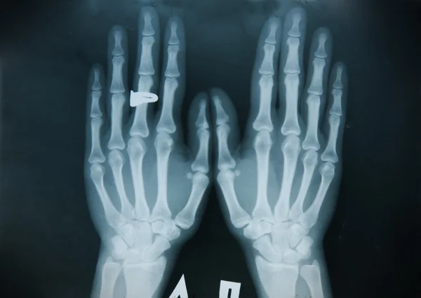 X-ray hand (finger) — Stock Photo, Image
